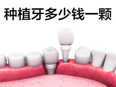 天津种植牙的价格一般是多少 种植牙大概需要多少费用