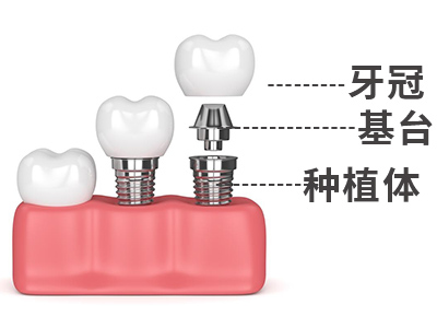 天津种植牙全部费用是多少-价目表已出