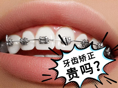 天津成人牙齿畸形矫正费用需要多少钱