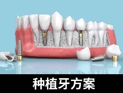 天津老年人种植牙能种几个牙根多少钱