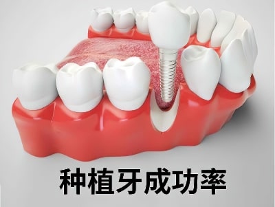 天津种植牙哪个齿科比较好种植牙的价格