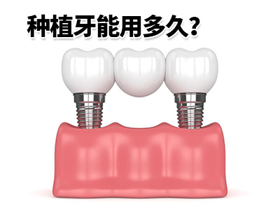 种植牙价目表-天津种牙看大概多少钱