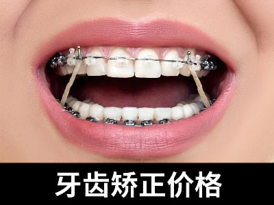 天津口腔医院牙齿矫正大概多少钱-牙齿矫正价格表