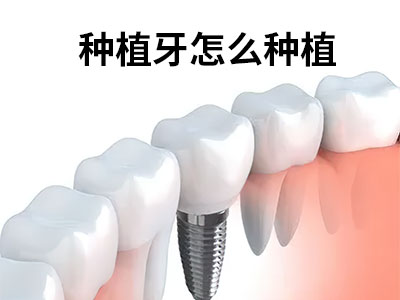  天津全口种植牙齿一般需要几颗牙-全口种植牙怎么种