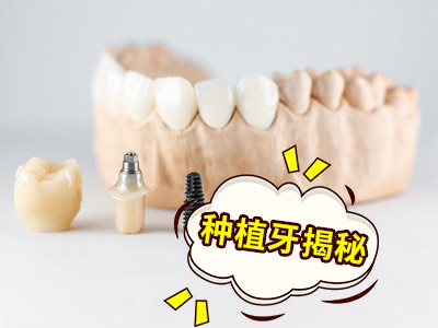 解答天津老年人种植牙多少钱一颗