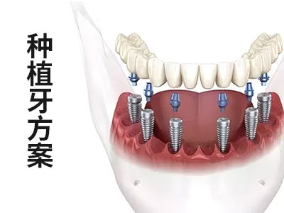 天津口腔医院做种植牙多少钱一颗
