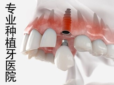 天津现在种植牙的技术哪家好 哪家医院做种植牙好