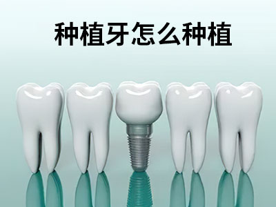 天津牙周炎拔牙一般要拔几颗-牙周炎就要拔牙吗