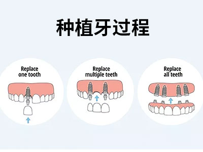  天津老人种植牙费多少钱一个- 天津种植牙一颗多少钱