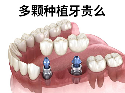天津50岁种植满口牙大概需要多少钱
