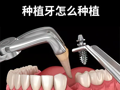 天津拔除智齿才能治疗牙周炎种植牙多少钱