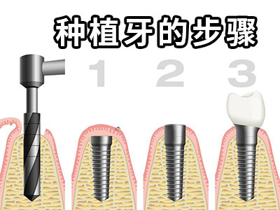 种植牙多少钱-天津即刻种植半口牙全部费用