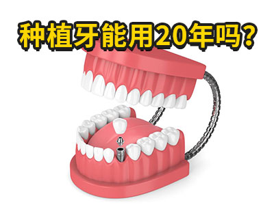 天津全口种植牙需要种几个牙根需要多少费用