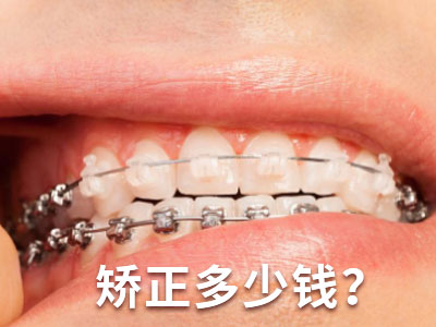 天津戴牙套去哪个医院牙齿矫正多少钱