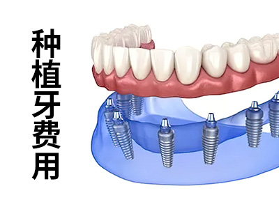 科普天津种植满口牙大概价格多少钱