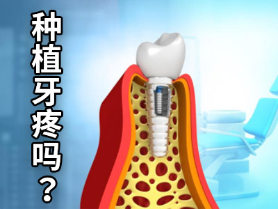  天津镶满口牙需要种植几颗义齿-全口义齿多少钱一副