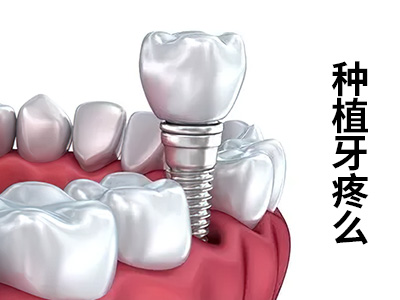 了解具体的天津数字化全口种植牙价格多少