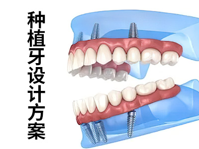 了解具体的天津种植义牙一颗价格是多少