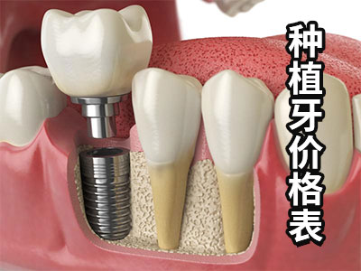 天津种植半口牙费用一般多少钱-天津种植牙价格表