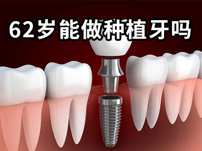 天津种植牙价格表2023-天津六颗半口种植牙要多少钱