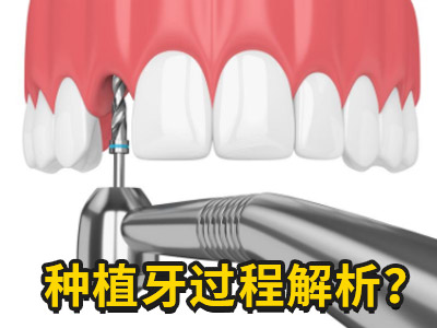 天津种植全口牙要种多少颗-天津种植牙牙科医院