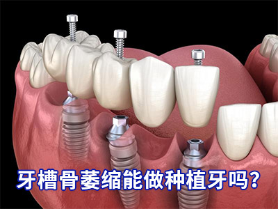天津口腔医院单颗牙种植费用-牙科医院天津