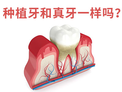 天津半口牙需种植几颗牙齿-天津种植牙的费用