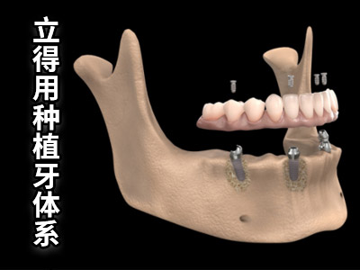 天津半口种植牙需要种几颗合适-天津种植牙