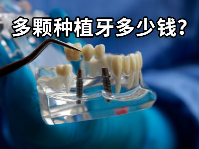 天津即刻种植牙种1颗牙的费用-天津种牙多少钱一颗2023