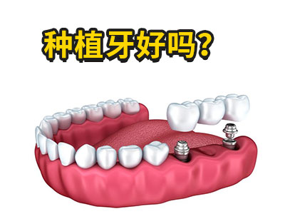 天津半口牙种植的口腔医院种植牙价格多少