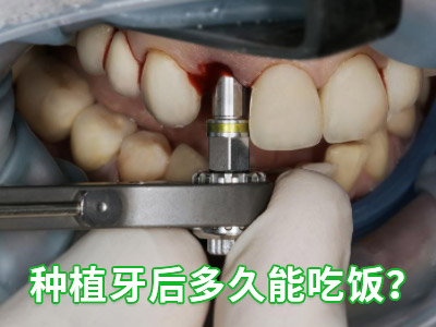 天津人工种植牙一颗价格是多少-现在天津种植牙多少钱
