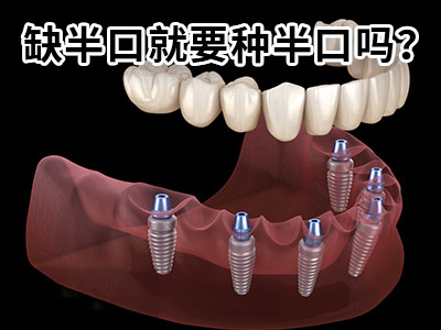 天津半口种植牙应该多少颗牙齿-天津种植牙的价格