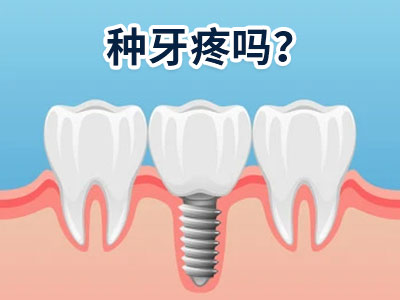 天津种牙多少一颗换种植牙需要多少钱