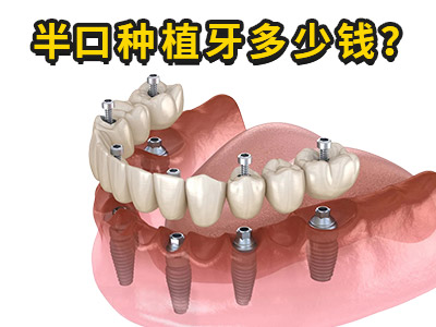 天津半口种植牙价格是多少钱