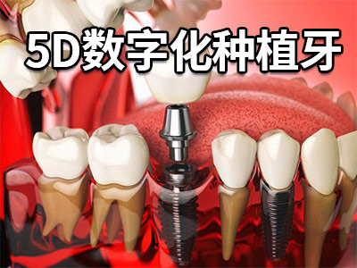 天津满口种植牙一颗多少钱啊-种植天津牙价格表