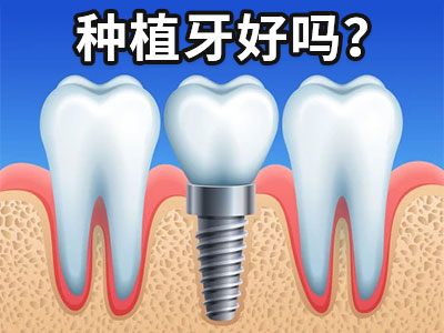 种植牙费用表天津2023-天津半口牙种植大概要花多少钱