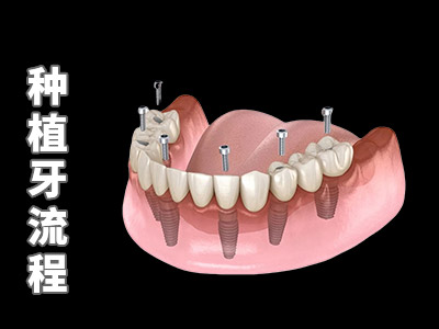 天津中诺口腔医院全口即刻种植牙价格表