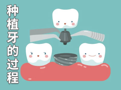 天津种植牙费用表-天津中诺口腔医院半口即刻种植牙多少钱