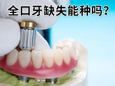 天津中诺口腔医院全牙拔后种几颗种植牙好要多少费用