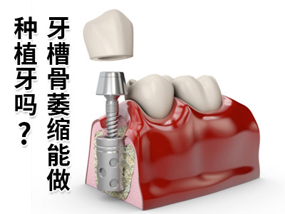 天津中诺口腔医院半口种植牙要种多少颗呢大概多钱