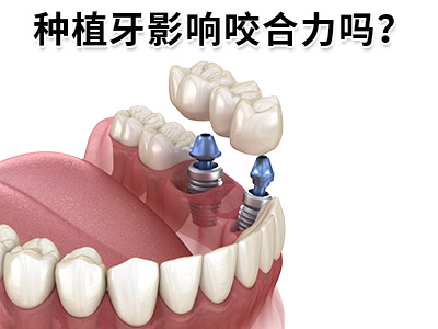 天津中诺口腔医院全口牙一共要种多少种植牙要多少费用