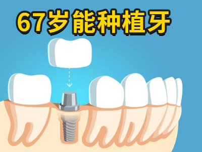 2023天津种植牙价格表-天津拔了牙种植一颗多少钱啊