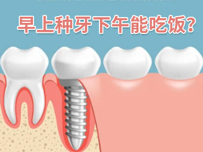 天津2颗种植体修复半口固定牙需要多少钱
