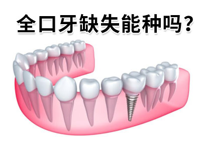 天津六个种植体修复半口牙价格要多钱