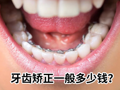 天津半口牙齿矫正价格是多少?天津牙科补牙收费价目表