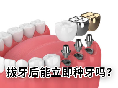 天津种植一颗牙一般多少费用需要多少钱