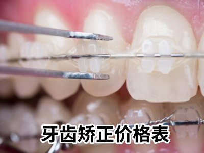 天津儿童龅牙做牙齿矫正需要多少钱?天津牙齿矫正全部费用