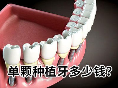 天津哪个牙科医院可以牙齿种植治疗需要多少费用