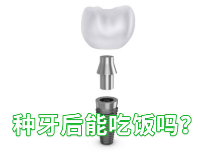 天津3d种植牙一般全口牙种植几个要多少钱