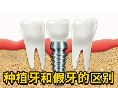 天津六颗种植牙修复半口牙费用要多钱